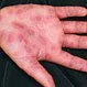 Picture of Erythema Multiforme 1