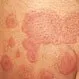 Picture of Erythema Multiforme 2