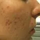 Picture of Erythematous Deep Acne Scars