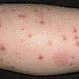 Picture of Flea Bites