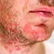 What Happens if Folliculitis Goes Untreated?