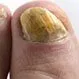 Picture of Fungal Nail Infection