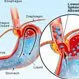 Picture of Gastroesophageal Reflux (GERD)