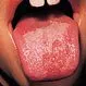 Picture of Geographic Tongue