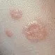 Picture of Granuloma Annulare