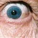 Picture of Graves Disease