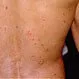 Picture of Guttate Psoriasis