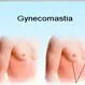 Gynecomastia (Enlarged Male Breasts)