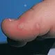 Picture of Hand-Foot-and-Mouth Disease on Foot