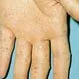 Picture of Hand-Foot-and-Mouth Disease on Hand 2