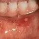 Picture of Hand-Foot-and-Mouth Disease in Mouth 2