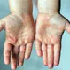 Can Adults Get Hand, Foot and Mouth Disease From Children?