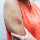 Hematoma vs. Bruise: Understanding the Key Differences