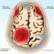 Hematoma