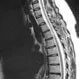 Herniated Disc