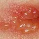 Picture of Herpes Blister (Cold Sore)