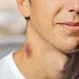 How Do You Get Rid of a Hickey in Seconds?