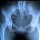 Picture of Hip Fracture