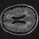 Picture of HIV-associated Dementia (HAD)