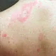 Are Hives and Rash the Same Thing?