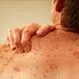 Are Hives (Urticaria) Contagious?