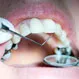 How Long Do Dental Fillings Last?