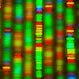 Hunter Syndrome (Mucopolysaccharidosis II, MPS II)