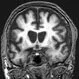 What Are the 5 Stages of Huntington’s Disease?