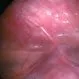 Hydrocele