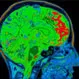 What Is the Main Cause of Hydrocephalus?