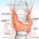 Hypercalcemia