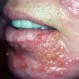 Impetigo