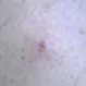 Ingrown Hair