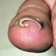 Ingrown Toenail