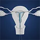 Is It Painful to Remove an IUD?