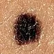 Picture of Junctional Nevus