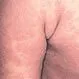 Picture of Kawasaki's Disease