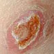 Picture of Leishmaniasis