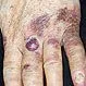 Picture of Less Common Skin Cancers