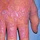 Picture of Lichen Planus 1