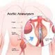 What Is Loeys-Dietz Syndrome?