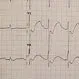 Low Potassium (Hypokalemia)