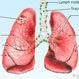 Can You Survive Metastatic Lung Cancer?