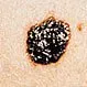 Picture of Malignant Melanoma