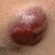 Picture of Merkel Cell Carcinoma