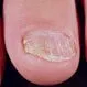 What Causes Nail Psoriasis?