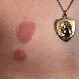 Picture of Nickel Contact Dermatitis from Necklace