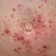 Picture of Nickel Contact Dermatitis