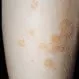 Picture of Nummular Eczema