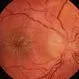 Optic Neuritis